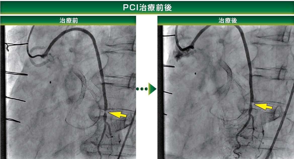 PCI治療前後　冠動脈造影図