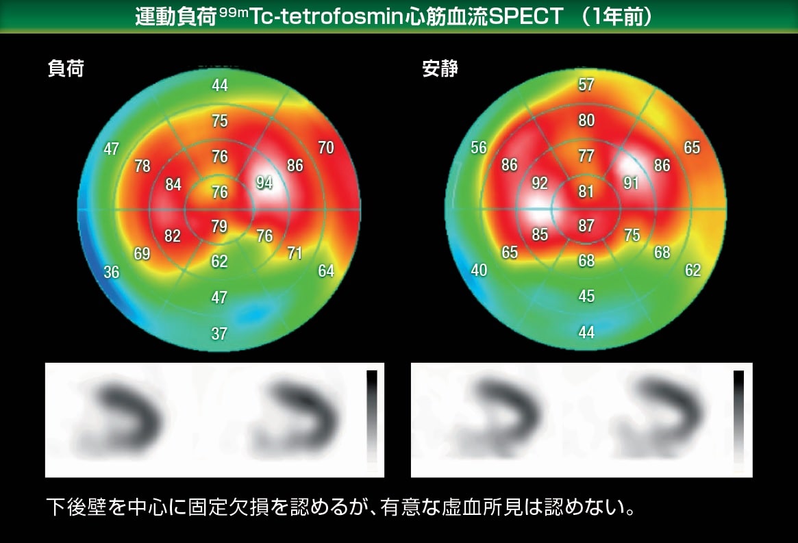 運動負荷99mTc-tetrofosmin心筋血流SPECT画像　1年前