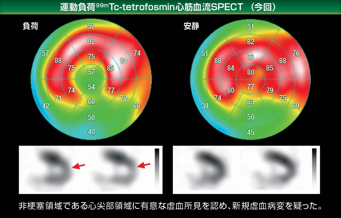 運動負荷99m-tetrofosmin心筋血流SPECT画像　今回