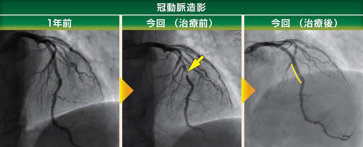 冠動脈造影画像　1年前　今回（治療前後）