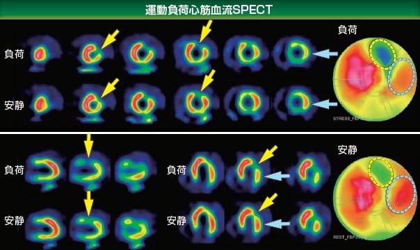 運動負荷心筋血流SPECT