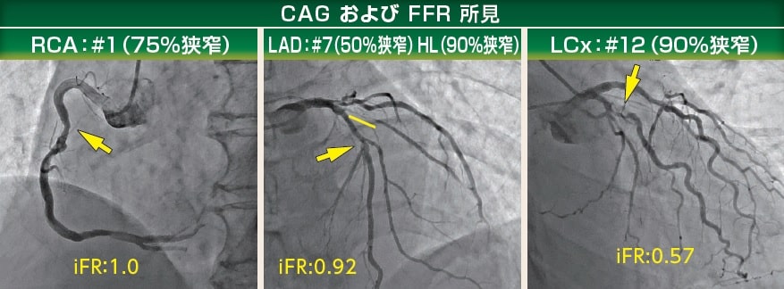 CAG および　FFR所見