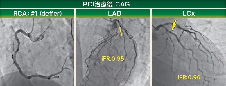 PCI治療後　CAG