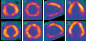 Tl/BMIPP SPECT像およびMIBG像