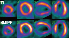 Tl/BMIPP SPECT像