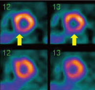心筋SPECT画像