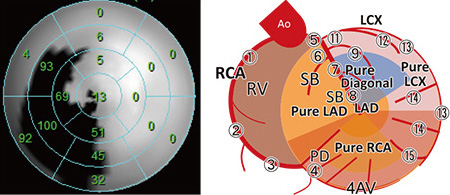 Polar mapの実例と冠動脈との関係