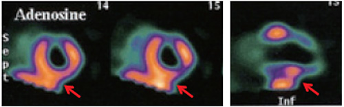 負荷心筋SPECT画像