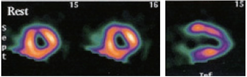 安静心筋SPECT画像