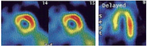 安静心筋SPECT画像