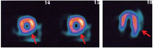 安静supine 心筋SPECT