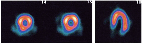 負荷prone 心筋SPECT
