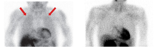 左）肺野の集積亢進あり　（右）集積亢進なしの画像