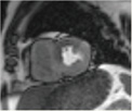 心筋perfusion MRI　画像例