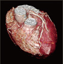 coronary MR angiography（MRA）画像例