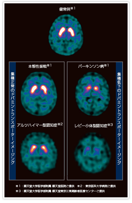 集積正常、集積低下のドパミントランスポーターイメージング