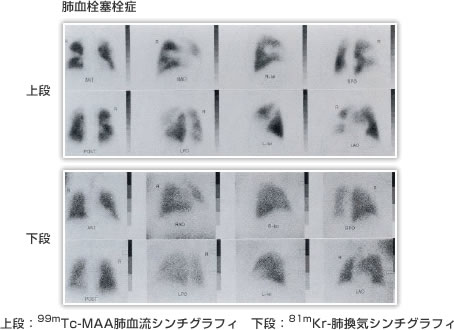 肺血栓塞栓症　肺血流・肺喚起シンチ画像