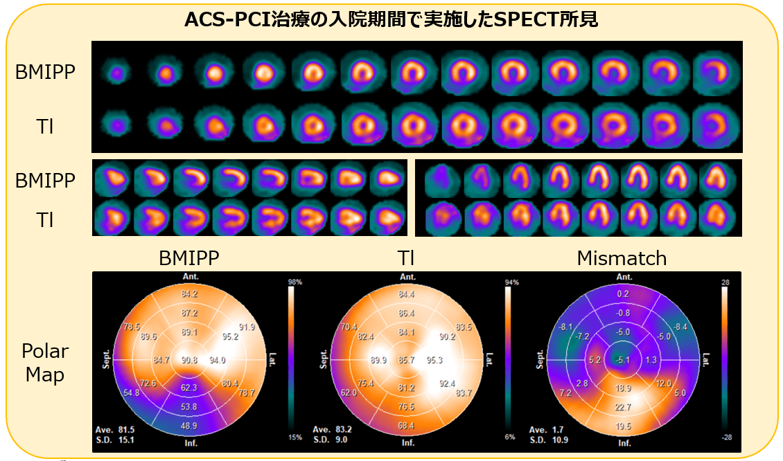 BMIPP-SPECT画像