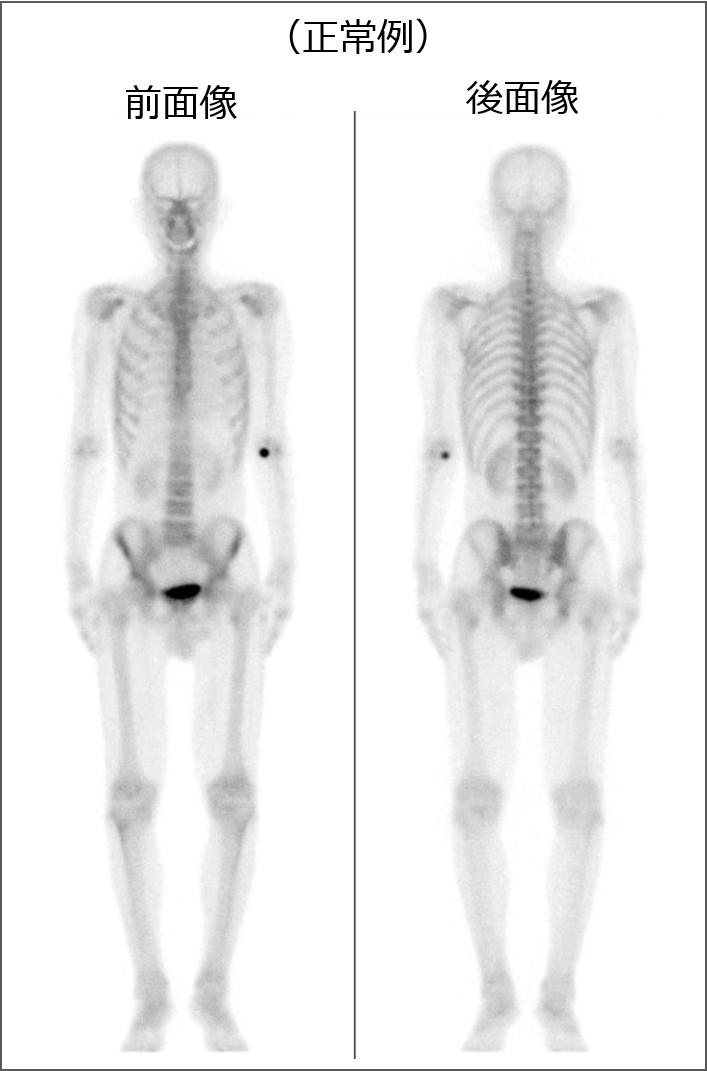 骨シンチグラム 正常例