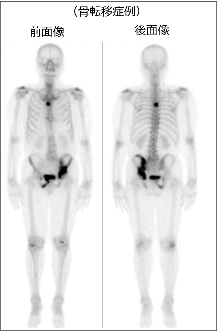 骨シンチグラム 骨転移例