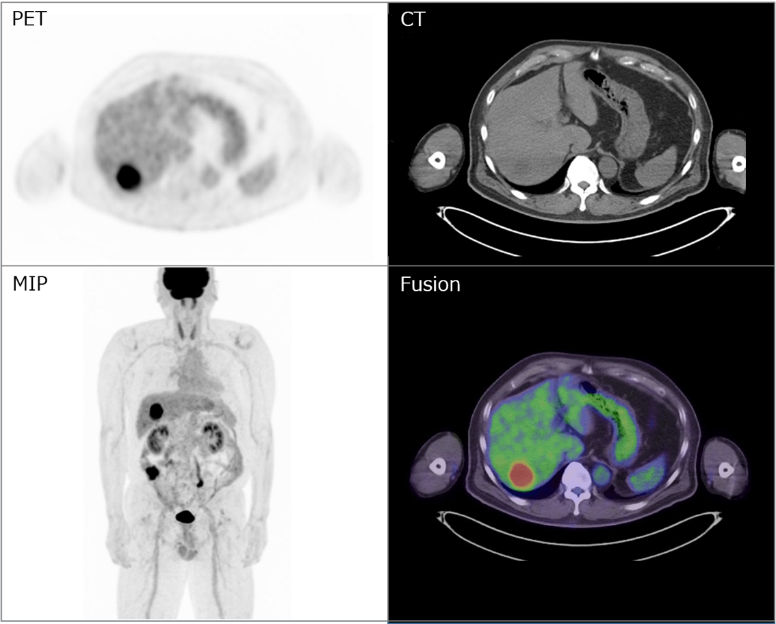 PET画像と形態情報としてのCT画像を融合させた融合画像