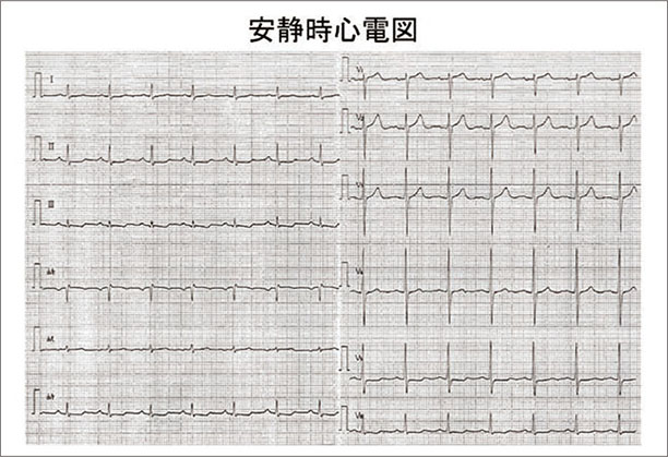 安静時心電図