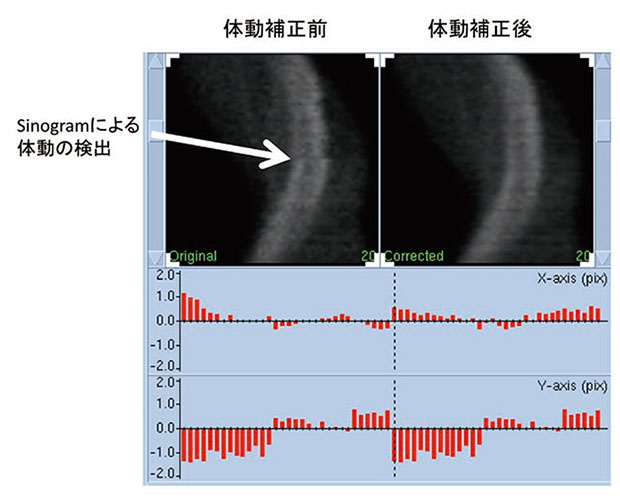 sinogramによる体動の検出