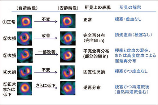 SPECT画像所見に基づく虚血と梗塞の診断　図