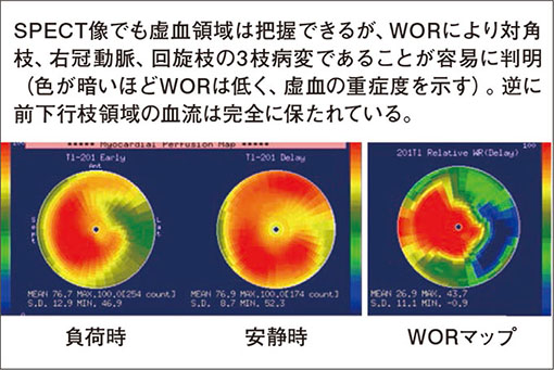 Tl SPECTの極座標表示　図