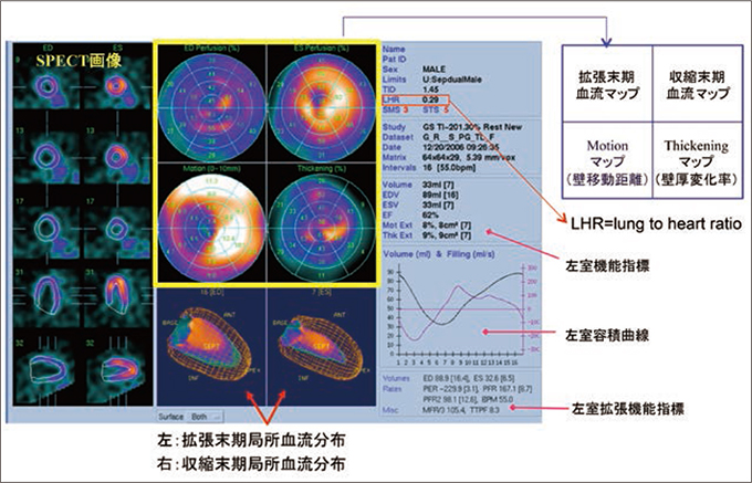 心電図同期SPECT QGS 画面