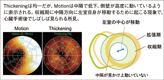 心臓手術後 冠動脈バイパス のThickeningとMotionマップ