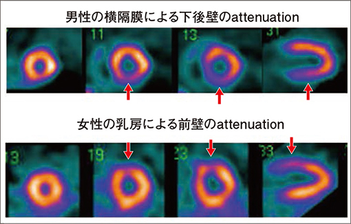 男性・女性に特有なattenuationによる集積低下