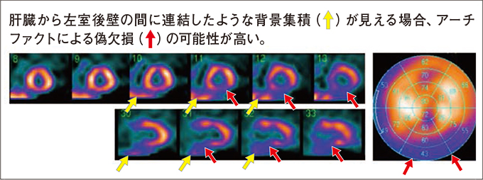 肝高集積による下後壁のアーチファクト 偽欠損