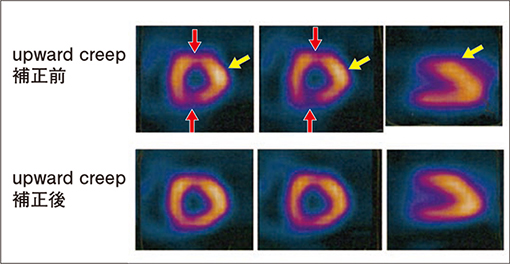 心臓の撮像中上方移動　upward creep　によるアーチファクトと補正