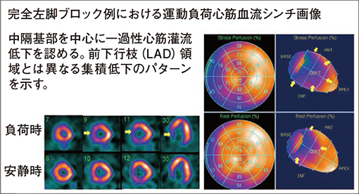 図12　完全左脚ブロックの症例