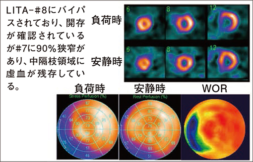 図13　冠動脈バイパス術後の残存虚血