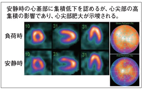 図15　心基部が全周性に低下する症例