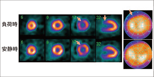 図14　前壁中隔基部に負荷Tl SPECTで再分布を認めた心サルコイドーシス