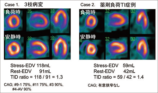 薬剤負荷でTIDを認めた症例