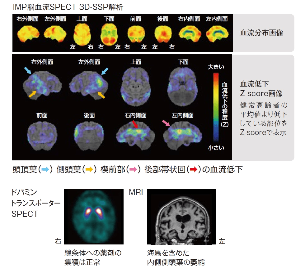 AD画像　IMP脳血流SPECT 3DSSP解析　ドパミントランスポーターSPECT MRI画像