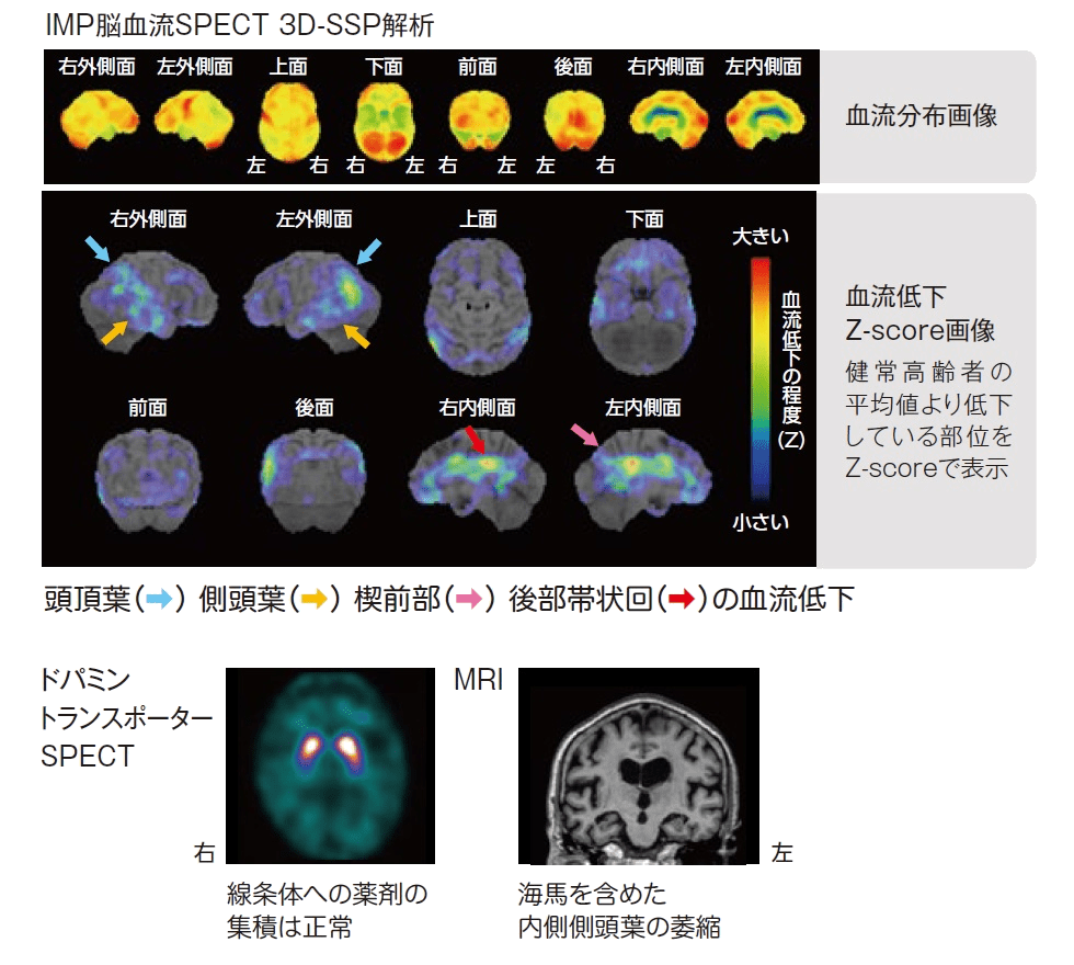 認知症鑑別診断のための脳SPECT画像所見 | 日本メジフィジックス株式会社