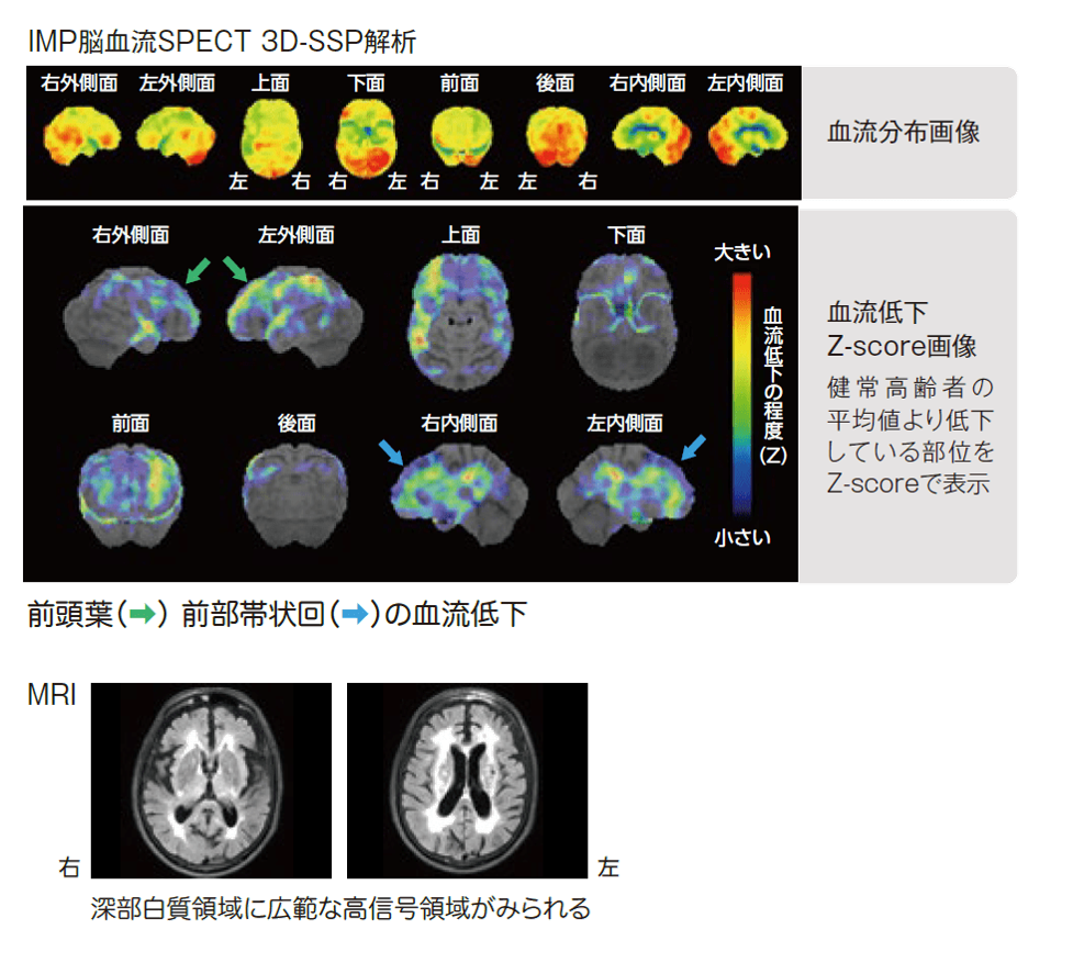 ビンスワンガー画像　IMP脳血流SPECT 3DSSP解析 MRI画像