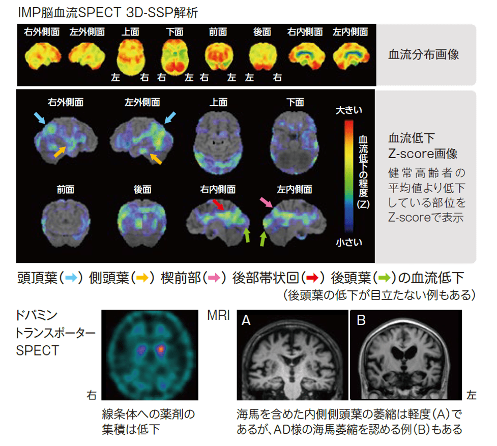 DLB画像　IMP脳血流SPECT 3DSSP解析　ドパミントランスポーターSPECT MRI画像
