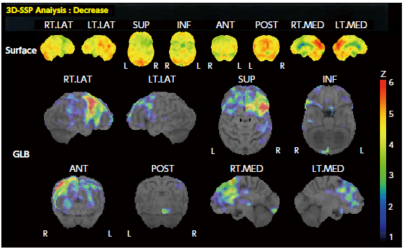 脳表血流分布画像とZ-score画像(3D-SSP)
