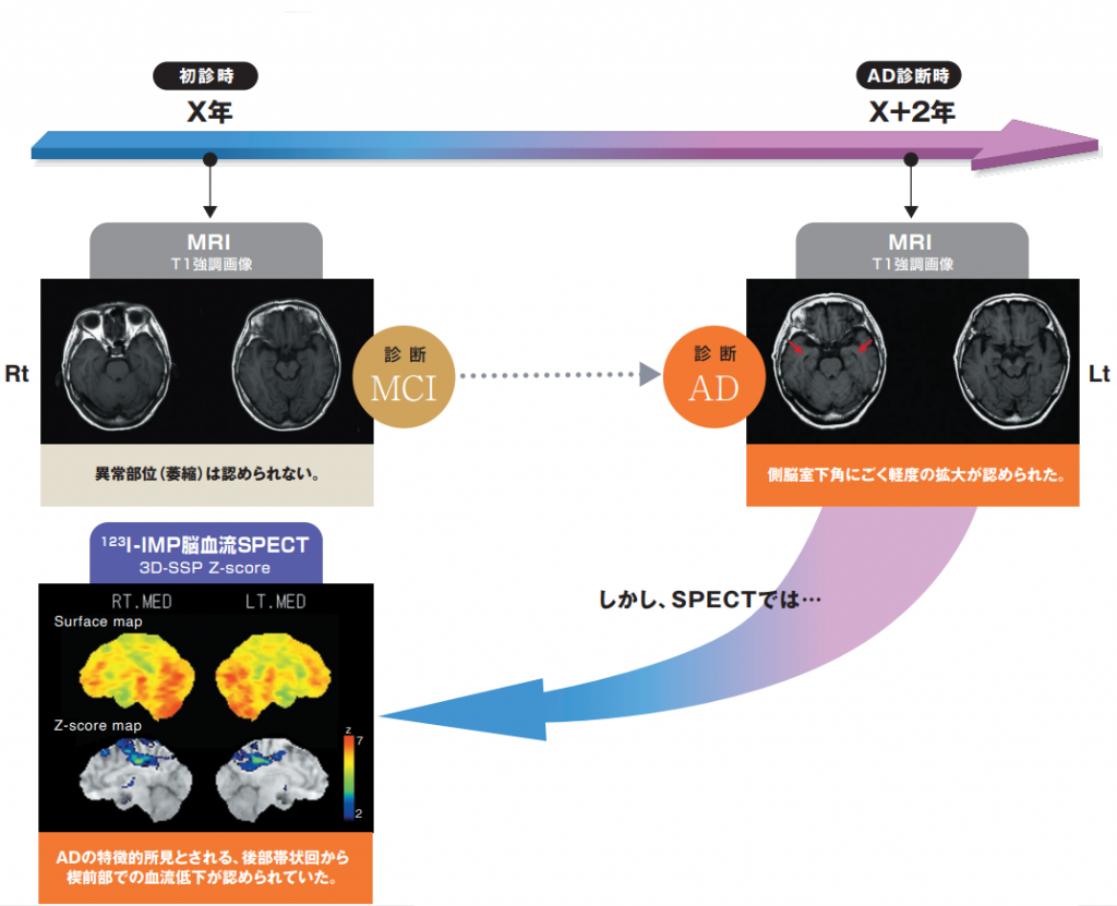 すでにSPECTは異常をとらえていました