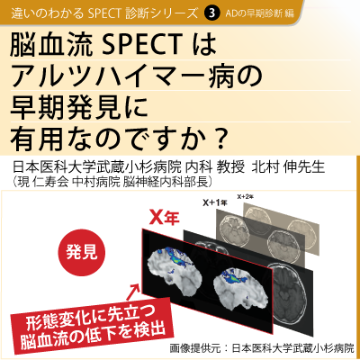 違いのわかるSPECT診断シリーズ 3　ADの早期診断 編