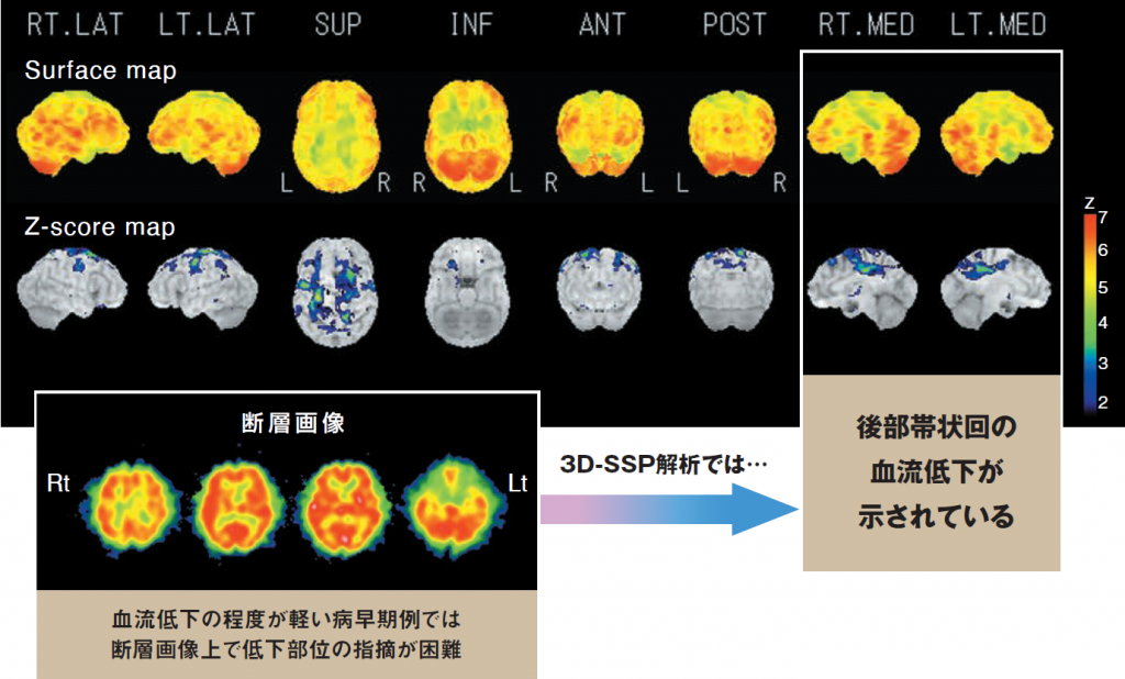 血流低下所見がわかりやすい、3D-SSP解析画像