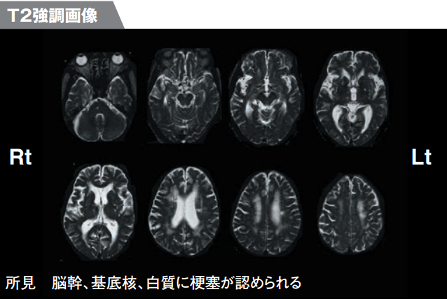 T2強調画像