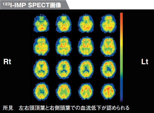 123I-IMP SPECT画像