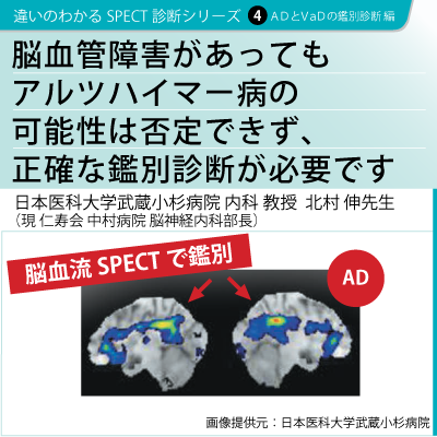 シリーズ4　脳血管障害があってもアルツハイマー病の可能性は否定できず、正確な鑑別診断が必要です